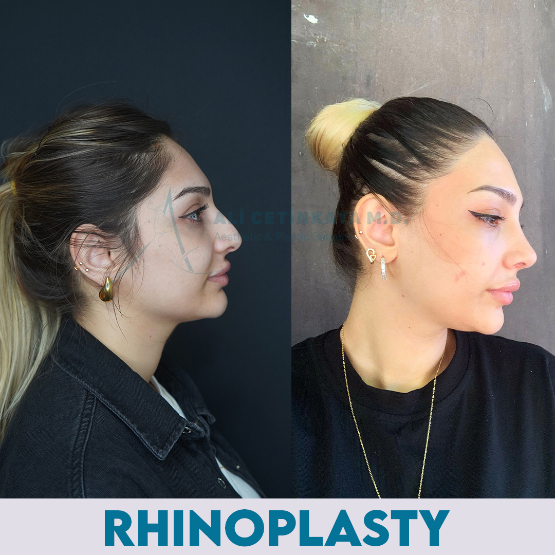 Deep plane facelift before and after results