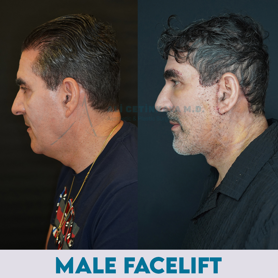 Deep plane facelift before and after - Patient 4