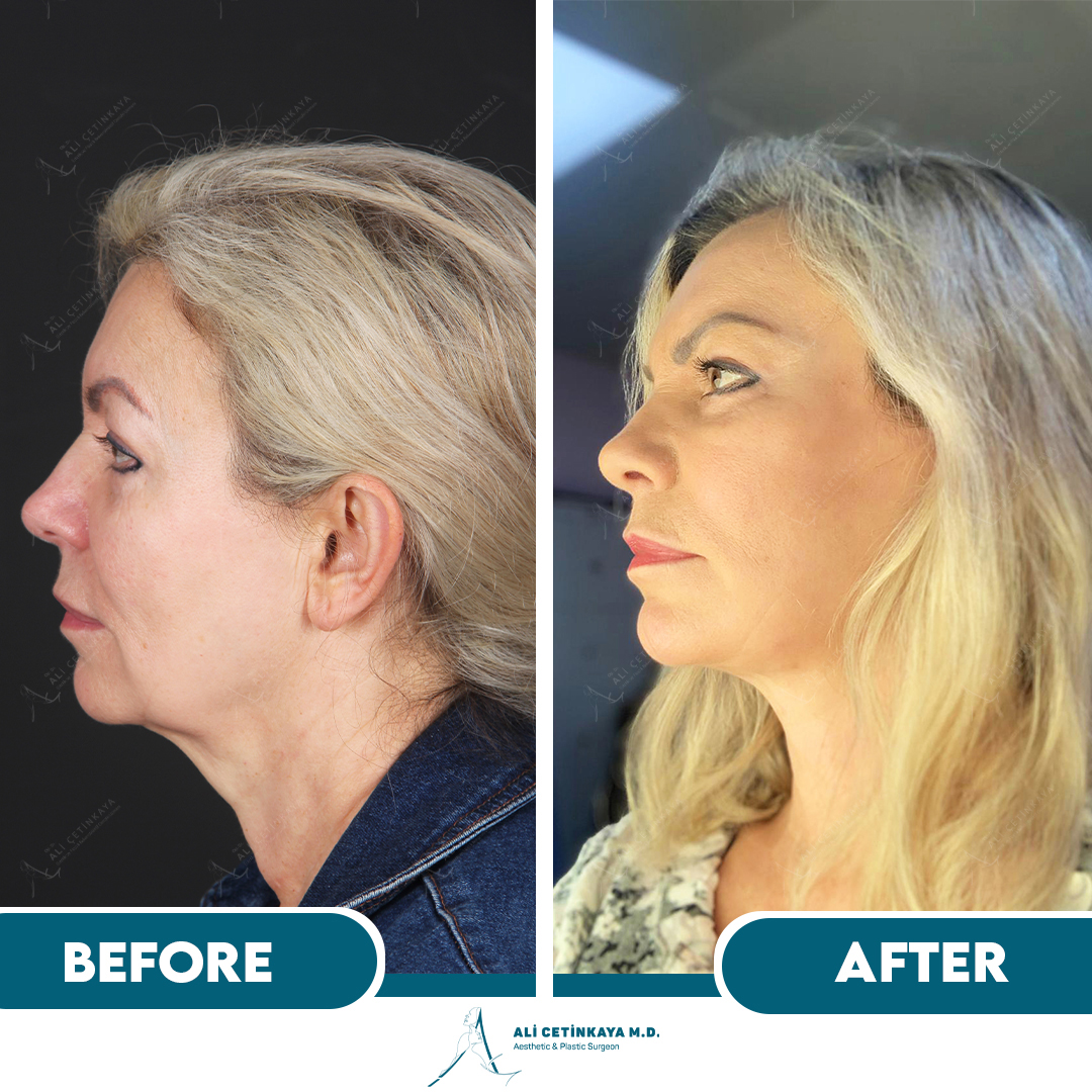Deep plane facelift surgery consultation