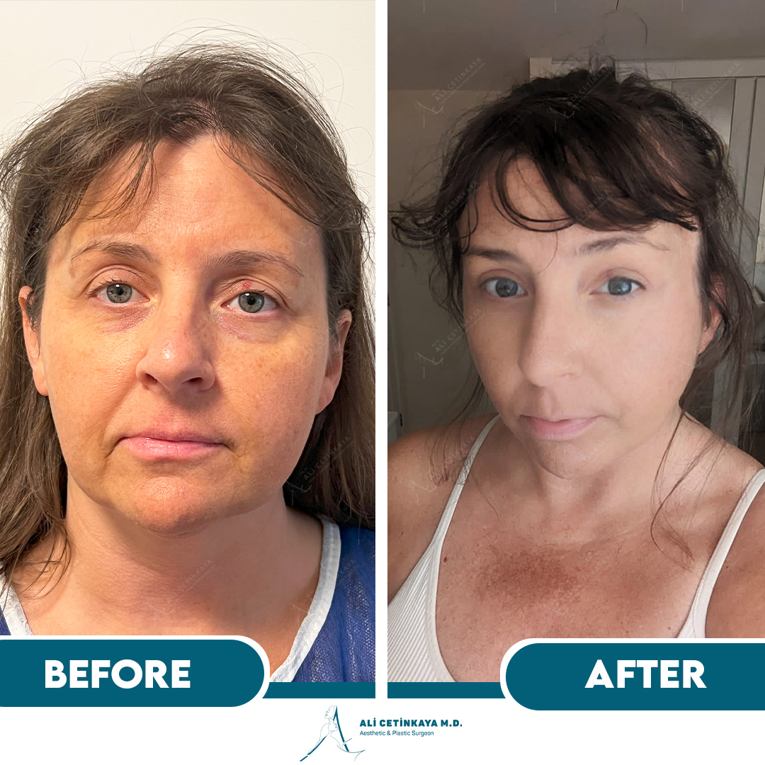 Facelift before and after - Patient 3