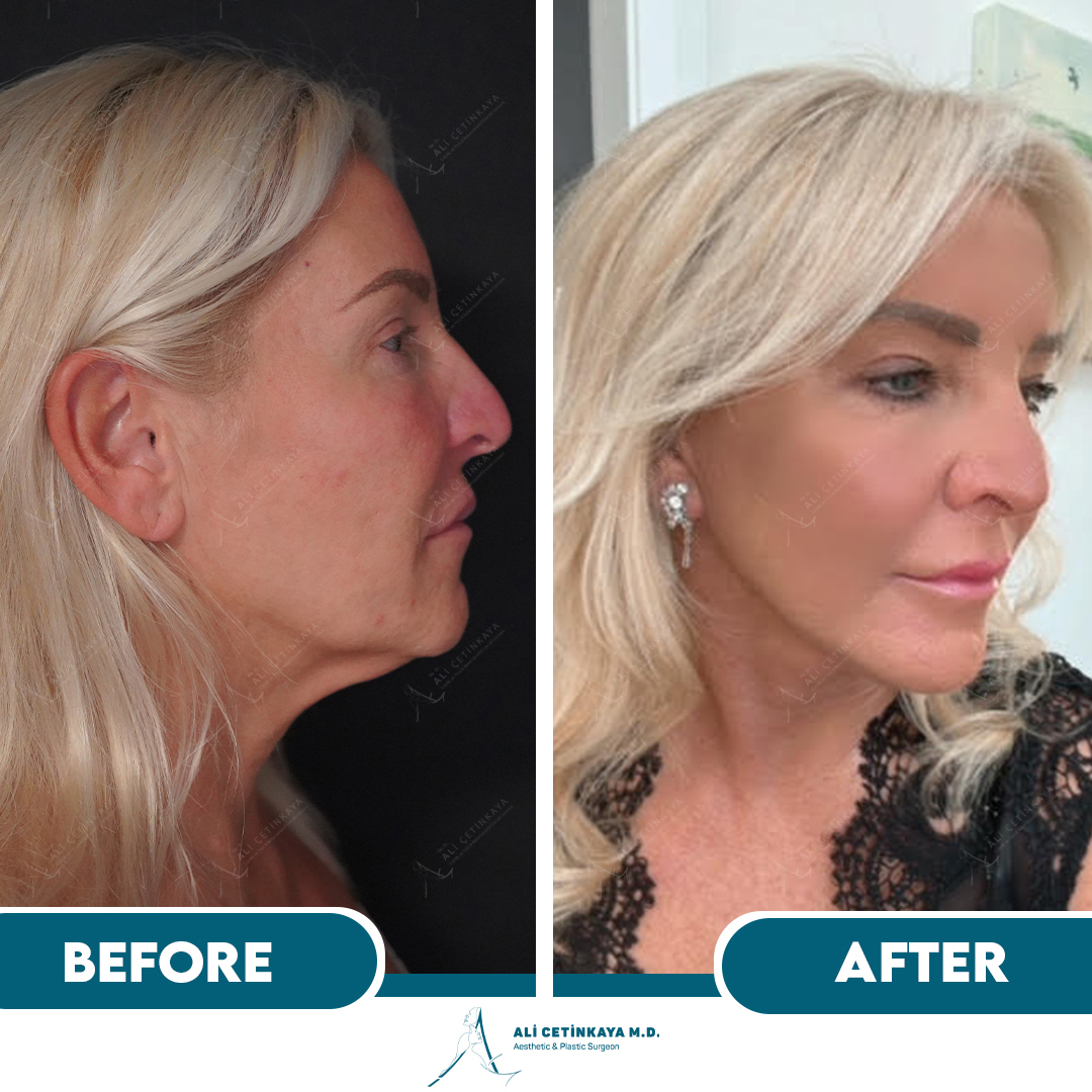 Facelift surgery