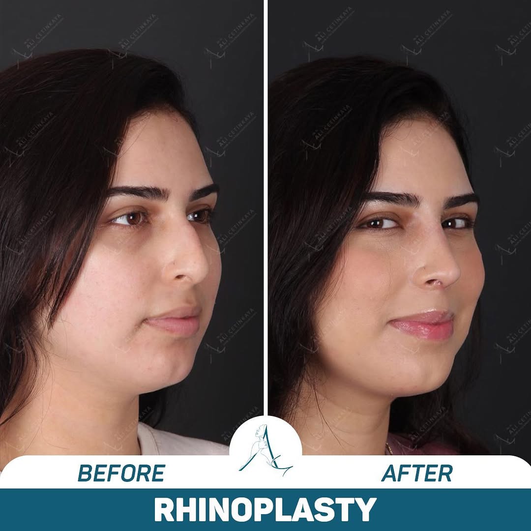 Rhinoplasty before and after - Patient 1
