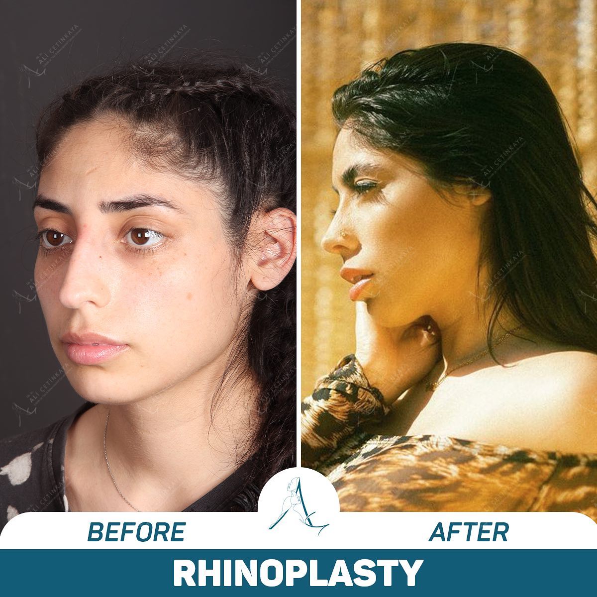 Rhinoplasty before and after - Patient 3