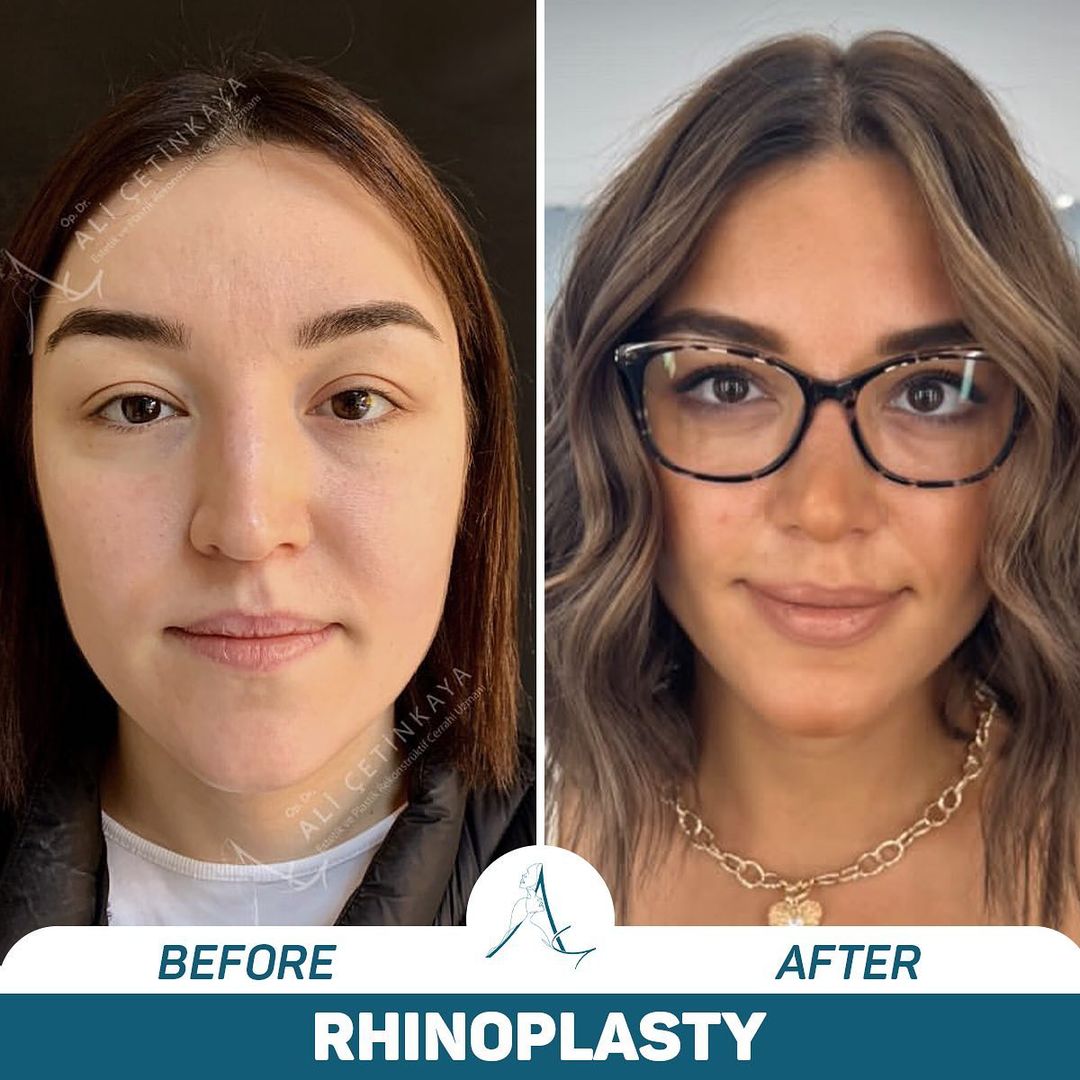 Rhinoplasty procedure explanation