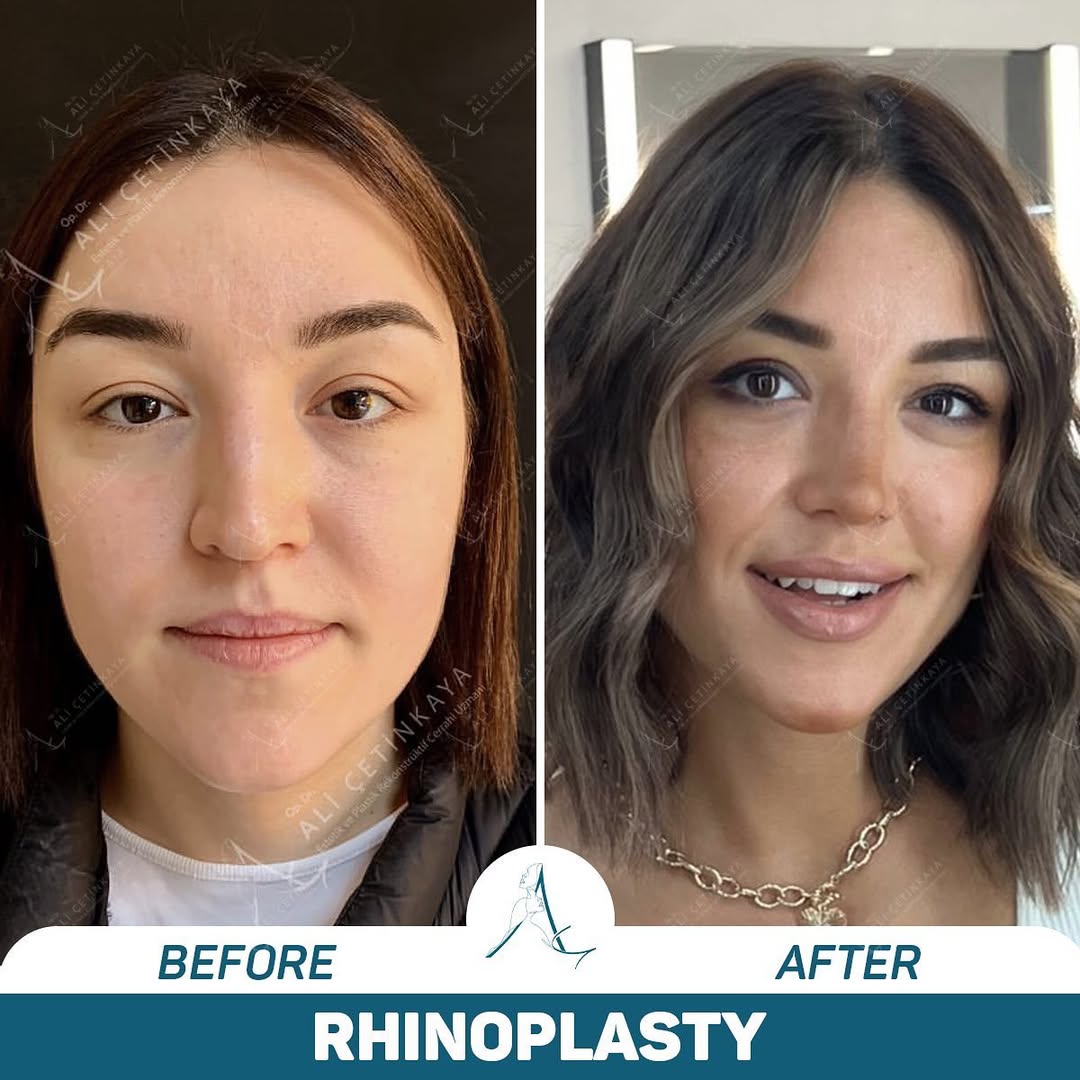 Rhinoplasty surgery