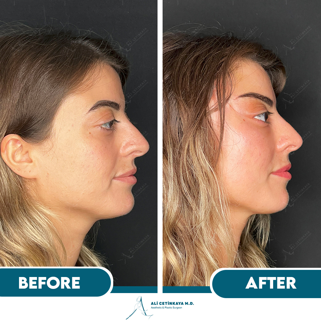 Temple lift before and after - Patient 2