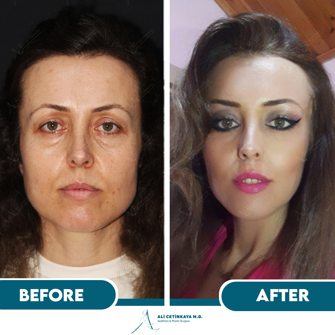 Temple lift before and after - Patient 3