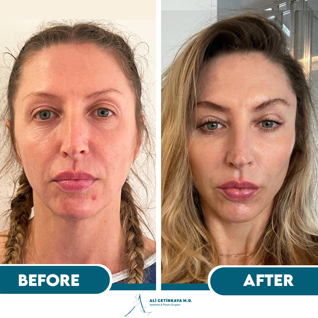 Temple lift surgery consultation